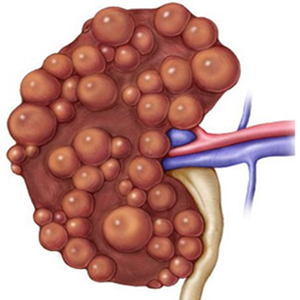 PKD basics